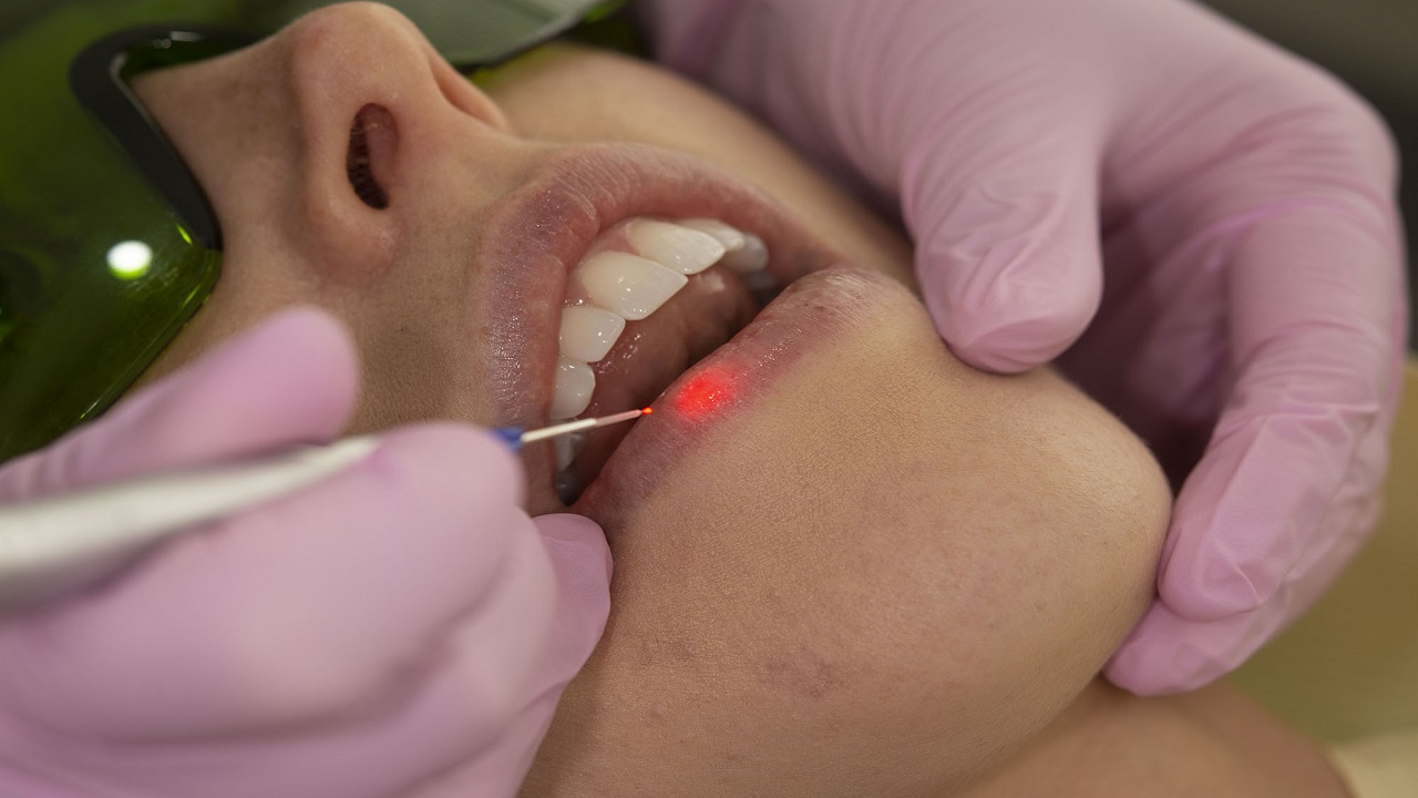 How Domer's Handheld Laser Can Be Helpful in Treating Cold Sores